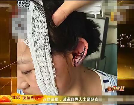 血肉模糊：女孩踢宠物狗一脚 牵狗大妈暴怒咬掉其耳朵/组图