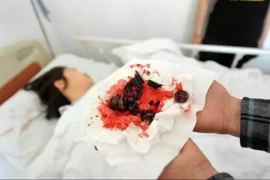 女子坐的升降椅突然爆炸 肠道取出十几块椅子碎片