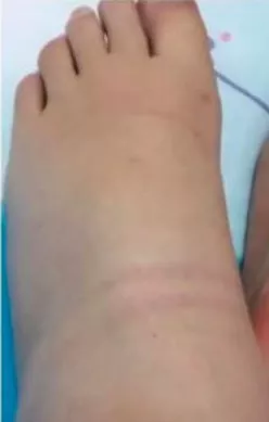 女子发照片晒自己丑丑的大象脚 却感动了朋友圈