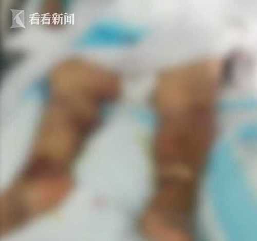 2a8d06c8580155b3b3b8a0a38a04e131.jpg 大妈洗虾时被虾尾刺中感染夺命细菌 脏器衰竭身亡