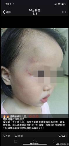 孩子刚入读幼儿园就被打? 疑因老师失恋被扇耳光
