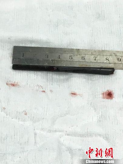 8.5厘米筷子“插进”头部3天不自知医生看了这样说…