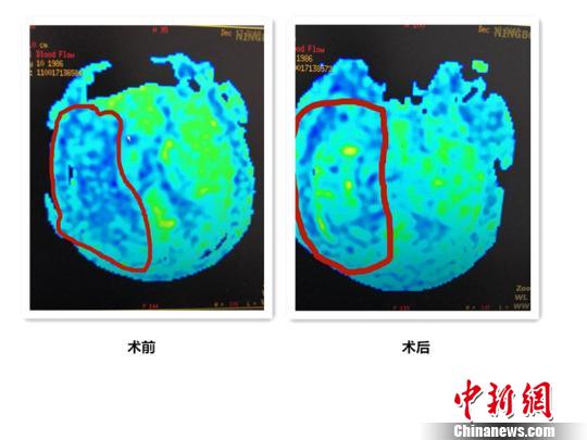 吃外卖、熬夜、少运动宁波32岁白领突发脑梗死