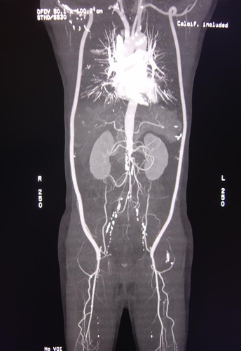 患者既往因Leriche综合征行双侧腋股动脉旁路治疗，术后CTA检查可见双侧旁路血管通畅。