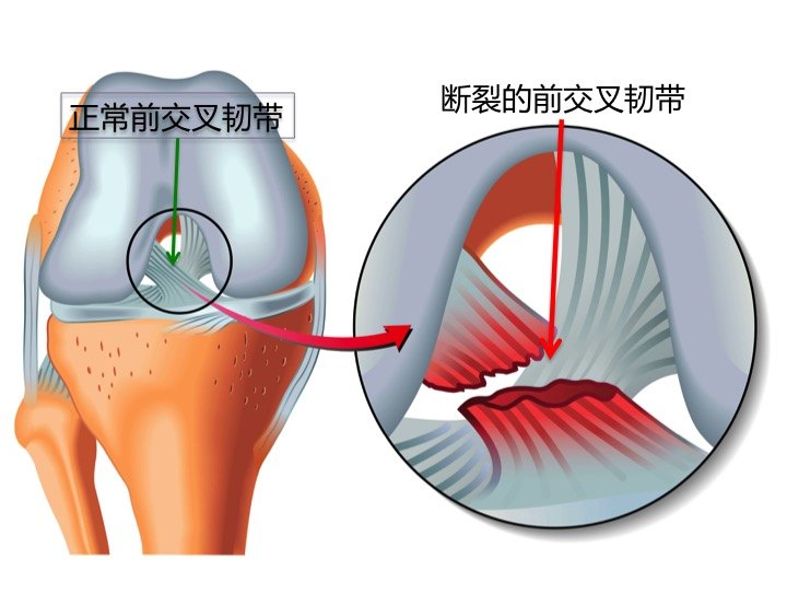 前叉受伤重建 这些误区要避免