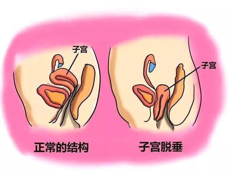 这个妇科病 多半是年轻时埋的雷