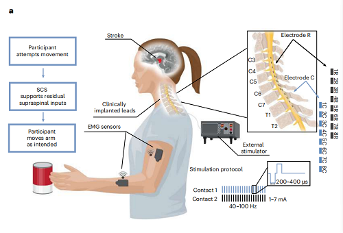 脊髓刺激恢复中风患者上肢功能