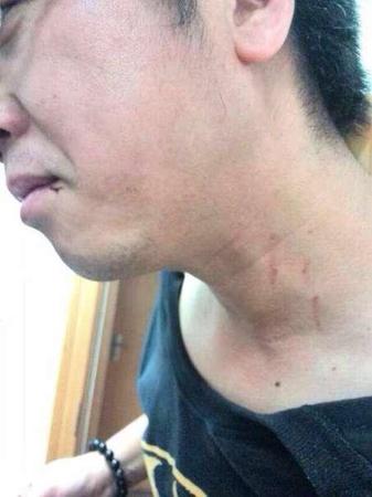 记者身上伤痕累累