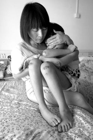　女童的外伤基本痊愈，但留下了明显的疤痕。京华时报记者蒲东峰摄