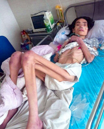 山东：女子因丈夫出轨自杀未遂-遭婆婆虐待饿成40斤5