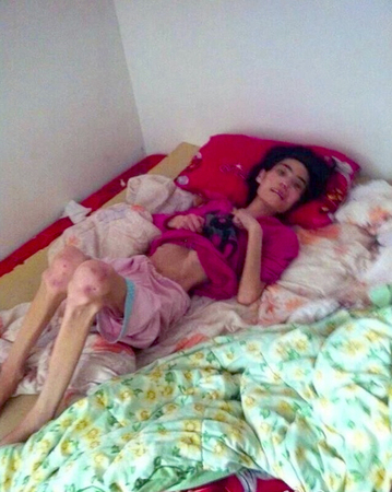 山东：女子因丈夫出轨自杀未遂-遭婆婆虐待饿成40斤4