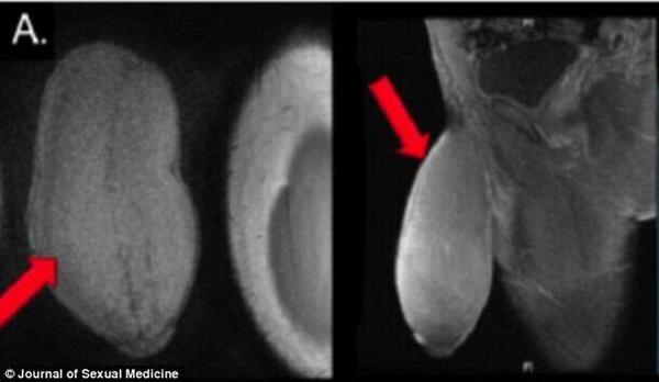 美17岁少年接受阴茎缩小手术 系世界首例