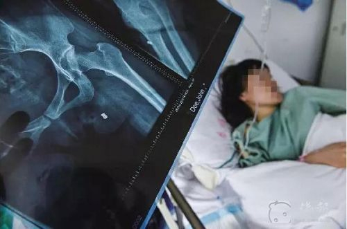 女子阳台遭枪击-臀部中弹深达20厘米2