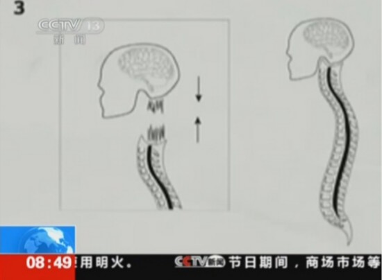 首例人类“换头”手术将实施：比死还难受