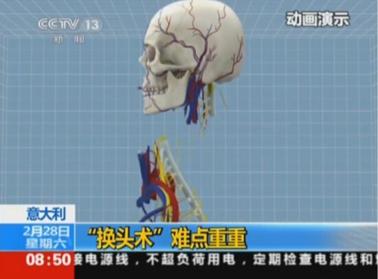 首例人类“换头”手术将实施：比死还难受