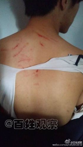 男学生衣服被撕破 背上有明显抓痕