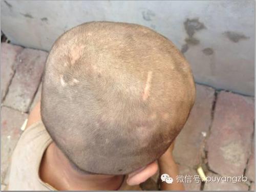 洪波的脑袋上，满是母亲殴打留下的伤痕。