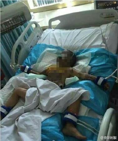 兄妹被人强灌硫酸女童惨死 男童被腐蚀皮肤黑青面目全非