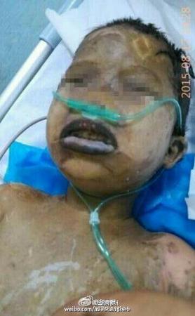 兄妹被人强灌硫酸女童惨死 男童被腐蚀皮肤黑青面目全非