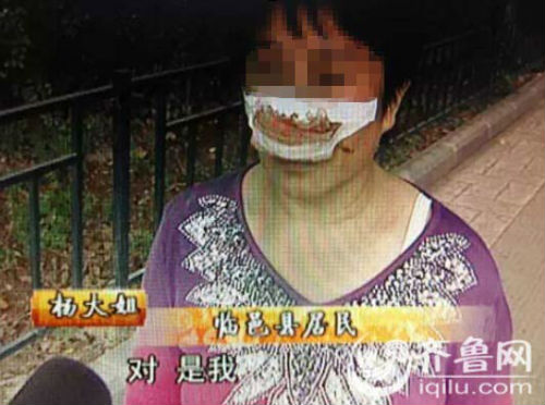 杨大姐自称来自德州临邑，鼻子是被丈夫一口咬掉的。（视频截图）