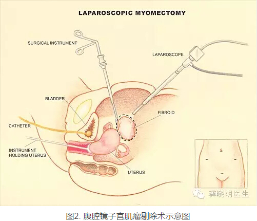 龚晓明：1/3女性都有的子宫肌瘤到底是啥