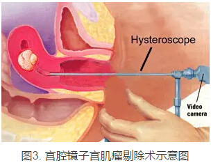 龚晓明：1/3女性都有的子宫肌瘤到底是啥