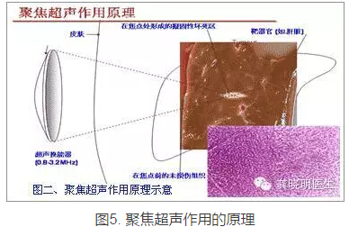 龚晓明：1/3女性都有的子宫肌瘤到底是啥