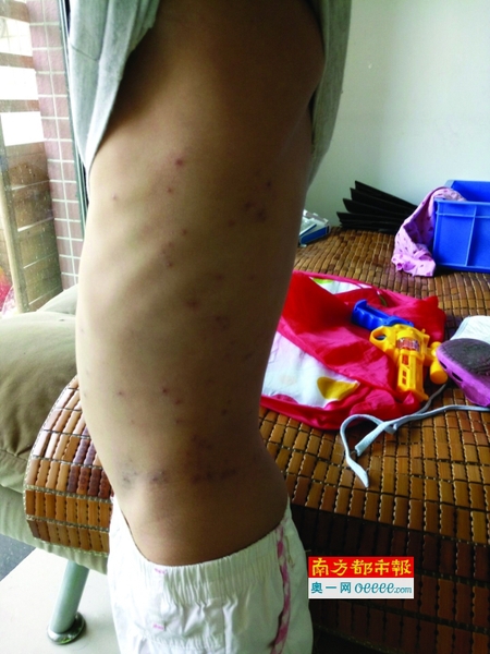 陈俊皓身上起了不少红疙瘩，奇痒无比