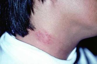 为什么年轻人也会得“带状疱疹”？