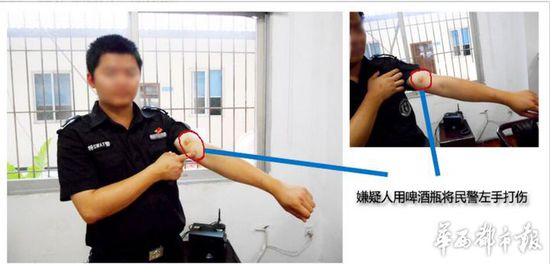 警察手上的伤
