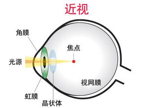 戴眼镜会让眼睛近视度数加深？