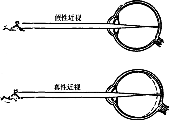 戴眼镜会让眼睛近视度数加深？