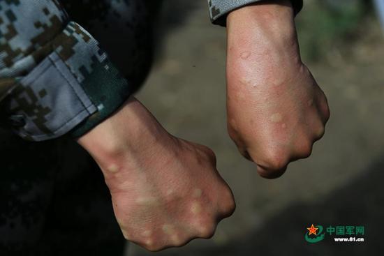 虽然戴着防蚊帽，穿着防护服，但巡逻回来，官兵的手上仍被蚊子叮起好多包。