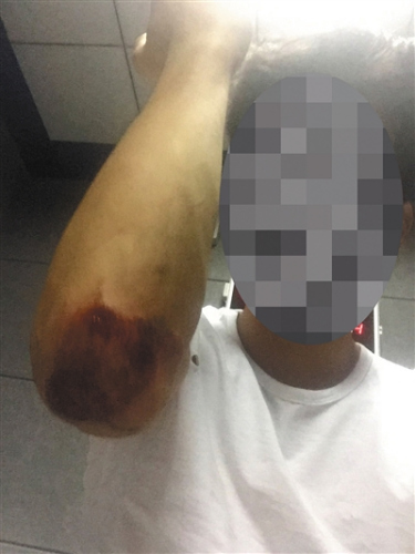 被警方抓捕时，不知情的黄诚进行了反抗，导致胳膊肘擦伤。