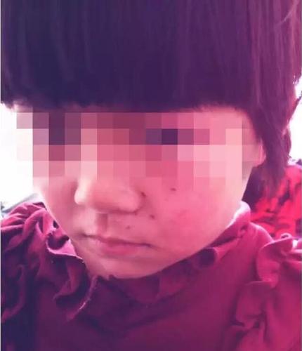 10+9没算好 郑州6岁女童小脸被“老师”扎6个洞