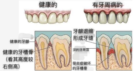 慎用牙签？牙缝真的越剔越大吗