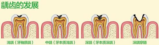 慎用牙签？牙缝真的越剔越大吗