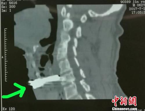 山西男子被砂轮直插咽喉伤口距颈动脉仅几毫米