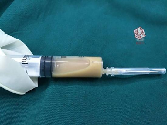 抽出来的脓液。