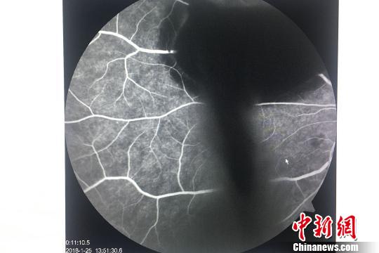 饮酒后剧烈呕吐致视力猛降小伙患“瓦尔萨尔瓦视网膜病变”