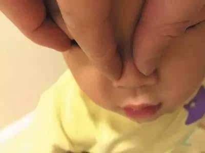 捏鼻梁让宝宝鼻子变挺？小心诱发2种病