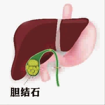如何护理胆结石？高危人群要注意