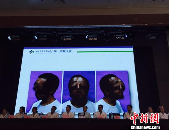 小伙患病貌似“狮面”，经手术重获新颜。　陈颖 摄