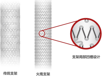 第二代传统药物洗脱支架与“火鹰支架”的结构设计对比