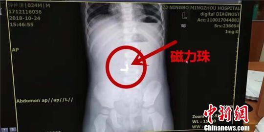 “熊孩子”贪玩误吞5颗磁力珠小肠磨破2个洞险丧命