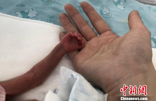 图为宝宝的小手。(院方供图) 张娅子 摄