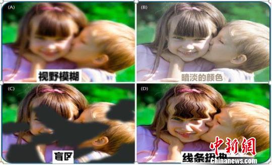 专家：糖尿病殃及黄斑当尽早治疗